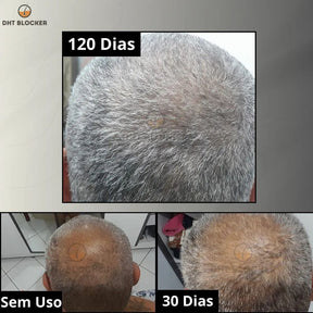 DHT Blocker - Força e Crescimento dos Fios